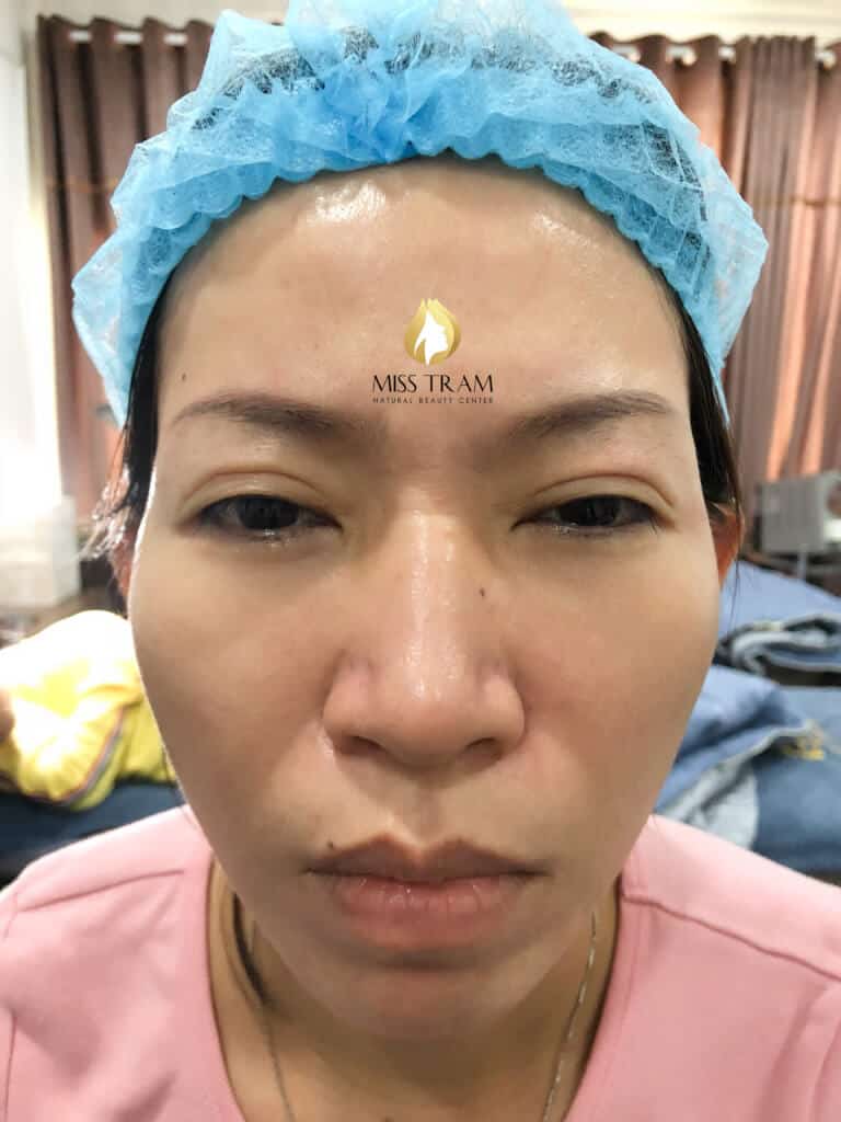 Before And After Treatment of Red Eyebrow - Natural Fiber Brow Sculpture 7