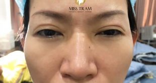 Before And After Treatment of Red Eyebrow - Natural Fiber Brow Sculpture 26
