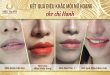 Before And After Queen Lip Sculpting Results For Women 9