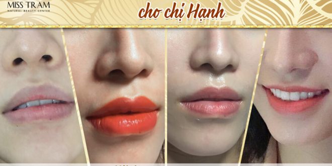 Before And After Queen Lip Sculpting Results For Women 4