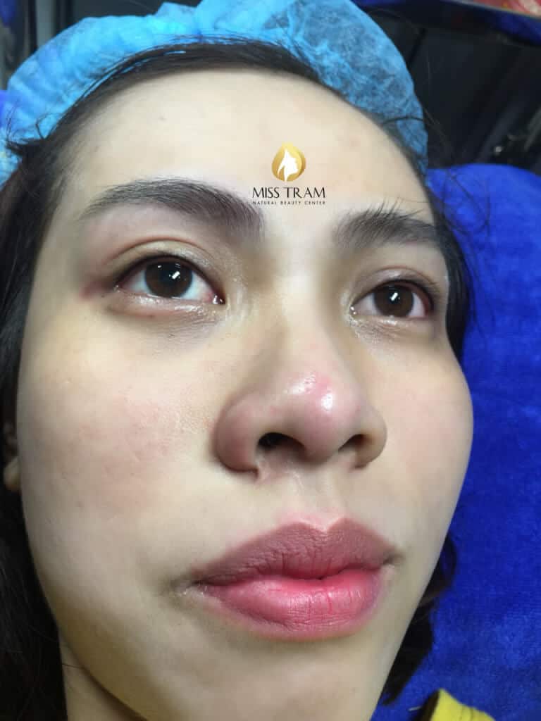 Before And After The Results Of Eyelid Spray For Female Customers 7
