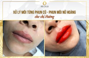 Before And After Treatment Of Old Lip Spray - New Queen Lip Sculpture For Women 21