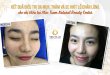 Before And After Clearing Acne - Tightening Pores With Fractional CO2 Laser Technology 28
