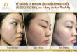 Before And After Acne Treatment With Fractional CO2 Laser Micro-Activation Technology 18