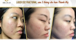 Before And After Acne Treatment With Fractional CO2 Laser Micro-Activation Technology 11