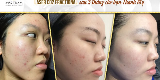 Before And After Acne Treatment With Fractional CO2 Laser Micro-Activation Technology 4