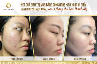 Trước Và Sau Điều Trị Mụn Bằng Công Nghệ Kích Hoạt Vi Điểm Laser CO2 Fractional 25