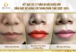 Before And After Deep Treatment And Beauty With Queen Lip Sculpture 30