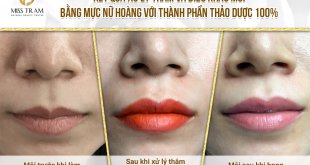 Before And After Deep Treatment And Beauty With Queen Lip Sculpture 17