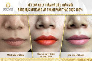 Before And After Deep Treatment And Beauty With Queen Lip Sculpture 26