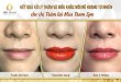 Before And After Treating Old Lips And Sculpting Queen Lips 9
