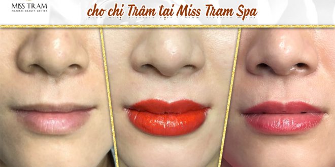 Before And After Treating Old Lips And Sculpting Queen Lips 4