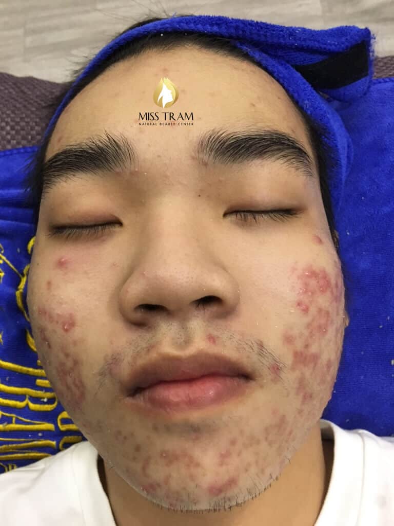 Before And After Acne Treatment, Possibility After 5 Months 12