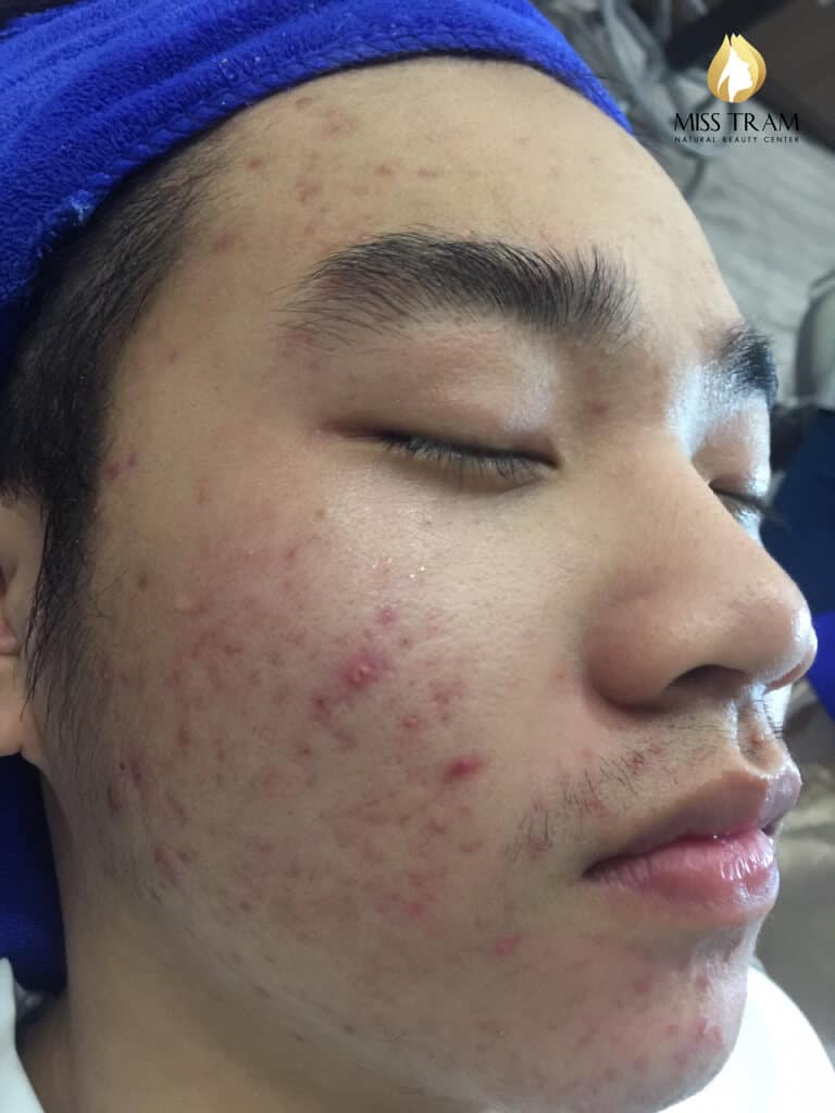 Before And After Acne Treatment, Possibility After 5 Months 13