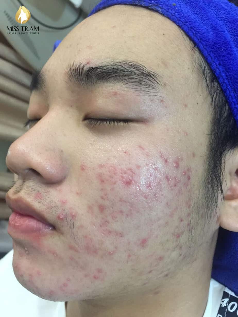 Before And After Acne Treatment, Possibility After 5 Months 14