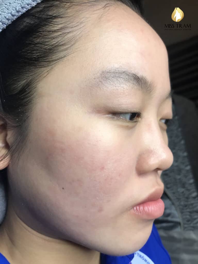 Before And After Acne Treatment With Fractional CO2 Laser Micro-Activation Technology 6