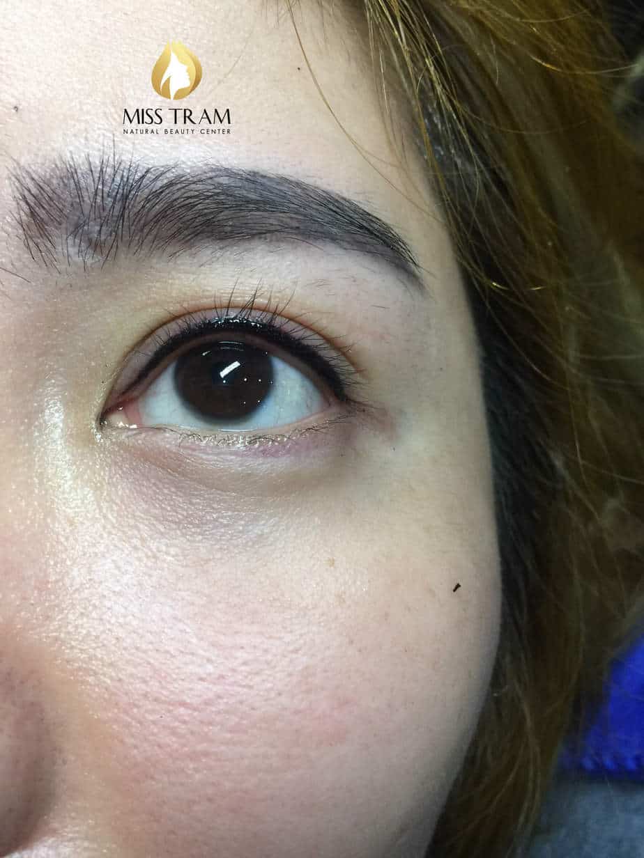 Before And After Eyelid Spray For Big, Sharp Eyes 6