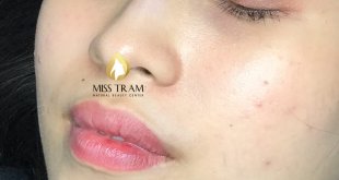 Before And After Deep Treatment And Beauty Collagen Lip Spray 1