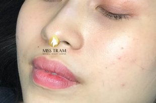 Before And After Deep Treatment And Beauty Collagen Lip Spray 16