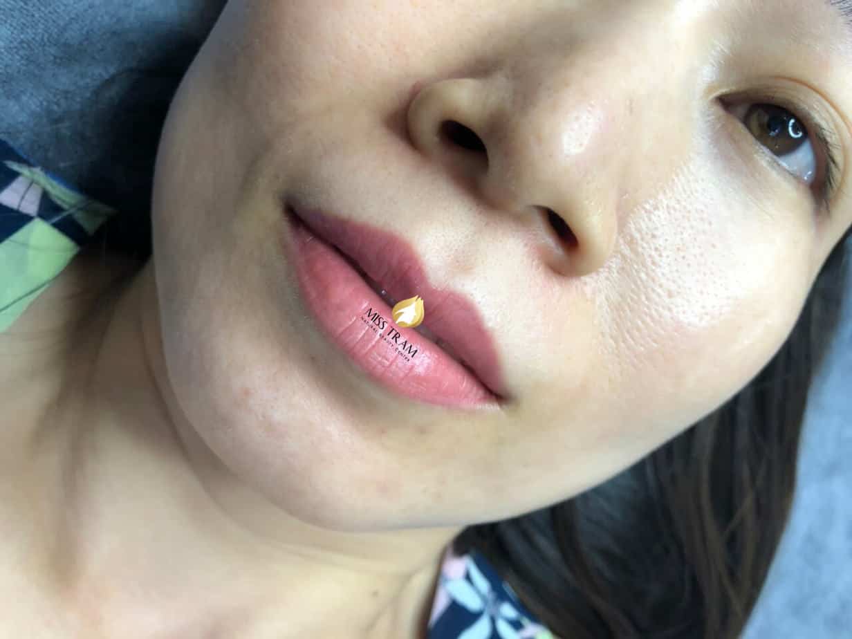 Before And After Deep Treatment And Beauty With Queen Lip Sculpture 7