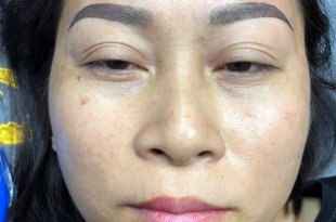 Before And After Treatment - Sculpture Combined with Eyebrow Powder Spray 35