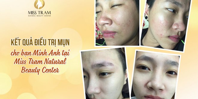 Before And After Acne Treatment With The Technology Of Combining Traditional Oriental Medicine 5