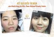 Before And After The Results Of Acne Treatment With Technology At Spa 81