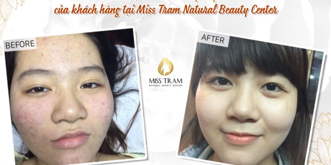 Before And After The Results Of Acne Treatment With Technology At Spa 4