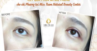 Before And After Beauty By Spraying Eyelids At Spa 1