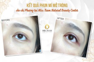Before And After Beauty By Spraying Eyelids At Spa 2