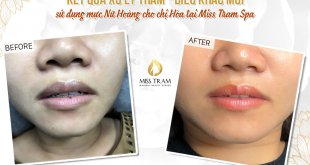 Before And After Deep Treatment And Sculpting Queen Lips 5