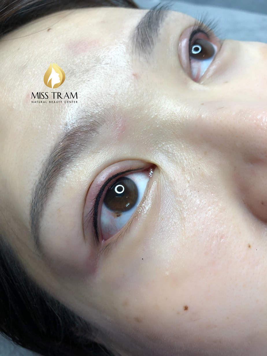 Before And After Beauty By Spraying Eyelids At Spa 8