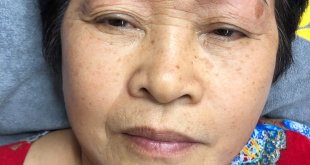 Before And After Treating Old Eyebrows - Head Sculpting Combined with Tail Powder Spraying For Women 18