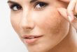 The Best Way to Consult & Treat Melasma for Customers 6