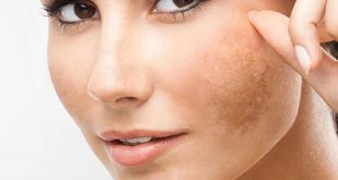 The Best Way to Consult & Treat Melasma for Customers 1