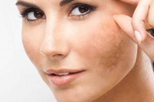 The Best Way to Consult and Treat Melasma for Customers 14