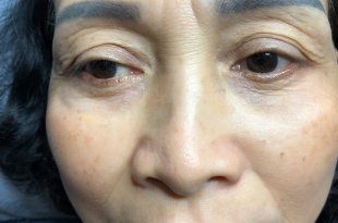 Before And After Beautifying Customers With Eyelid Spray Method 40