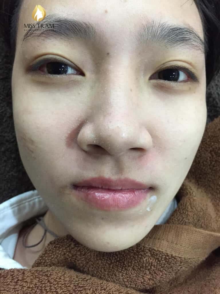 Before And After Acne Treatment With The Technology Of Combining Traditional Oriental Medicine 8