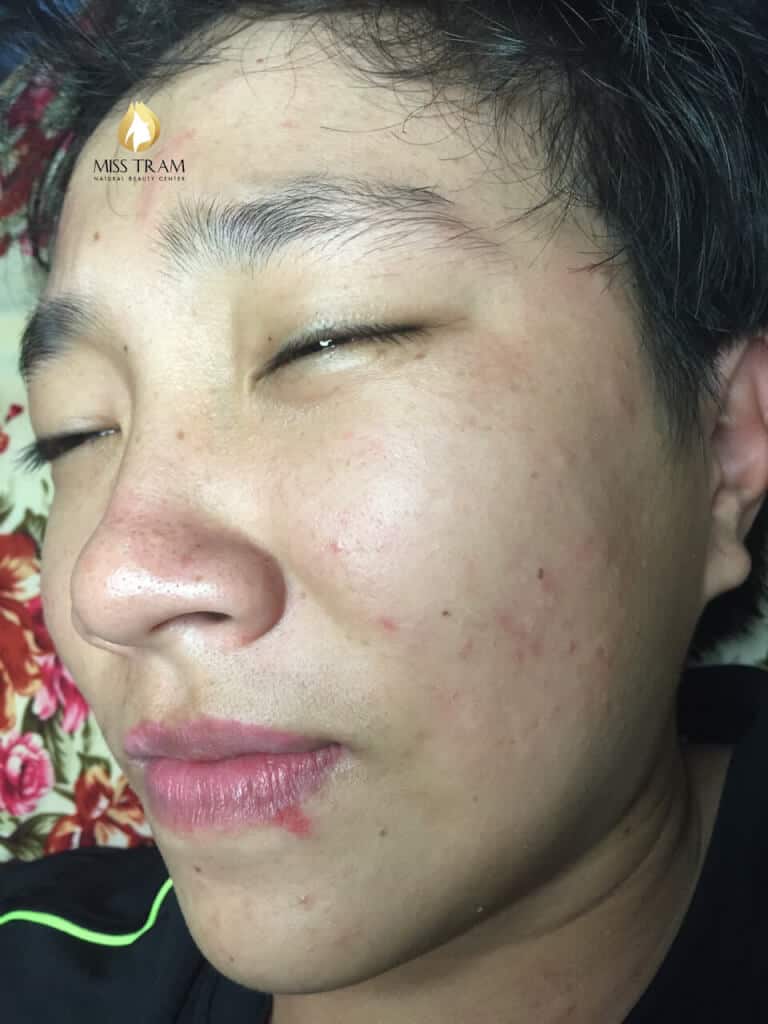 Before And After Acne Treatment With The Technology Of Combining Traditional Oriental Medicine 7