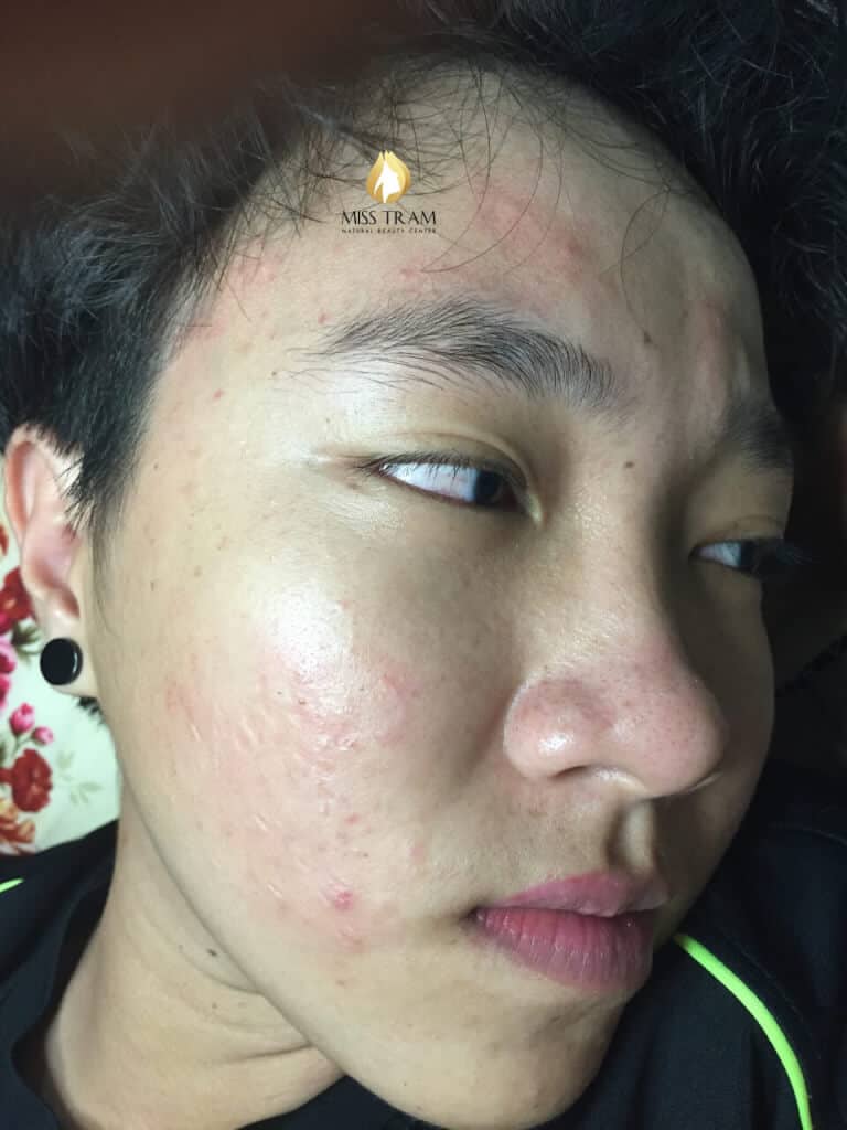 Before And After Acne Treatment With The Technology Of Combining Traditional Oriental Medicine 6