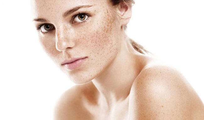 What Should People With Melasma Eat? 3