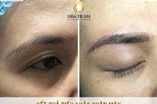 Before And After The Results Of Eyebrow Sculpting To Fix Small Eyebrow Shape 11