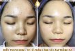 Before And After Acne Skin Treatment - Tighten Pores And Whiten Skin 28