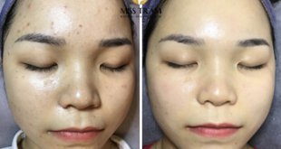 Before And After Acne Skin Treatment - Tighten Pores And Whiten Skin 2