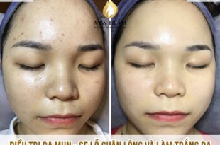 Before And After Acne Skin Treatment - Tighten Pores And Whiten Skin 54