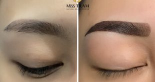 Before And After The Results Of Treatment Of Old Eyebrows Bleeding And New Eyebrow Spraying 10