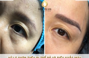 Before And After Treatment of Red Embroidered Eyebrows and Queen Eyebrow Sculpture 11