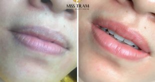 Before And After Deep Treatment - Beautiful Collagen Lip Sculpting For Women 5