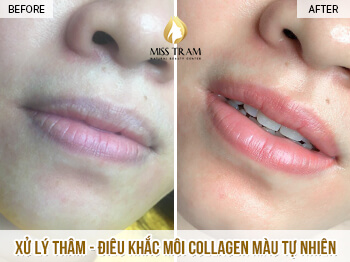 Before And After Deep Treatment - Beautiful Collagen Lip Sculpting For Women 2