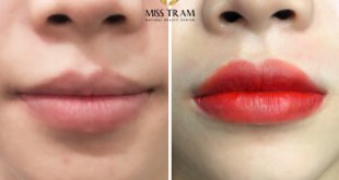 Before And After Lip Treatment And Sculpting Collagen Fix Pale Lips 5